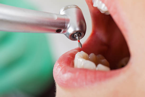 Best Emergency Tooth Extraction in Denver, PA